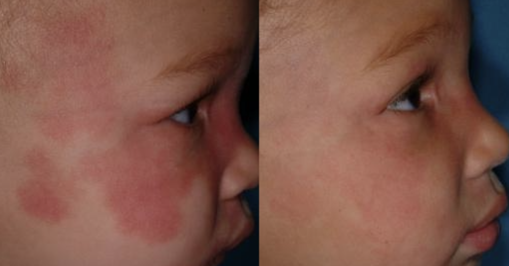 Feuermal Vorher Nachher Vorher Nachher Dermatologie Hanau